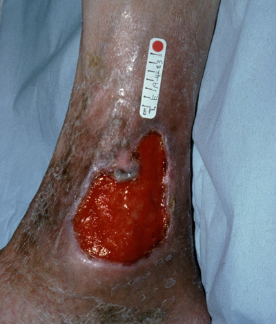 Leg Ulcer Example CliniMed